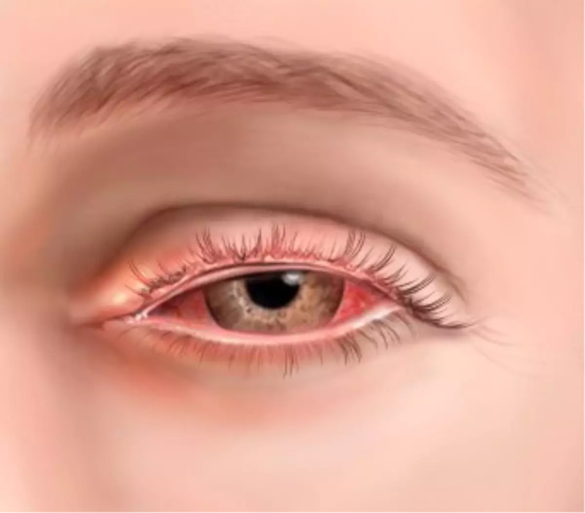 Ester Yapılı İlk Steroid Lotemax Artık Geri Ödemede