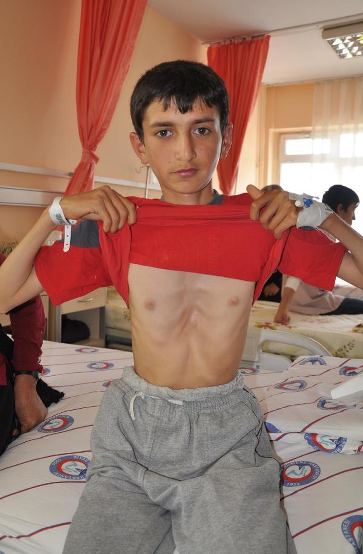 Sivas\'ta Göğüs Deformiteli 24 Öğrenciye Aynı Gün Ameliyat