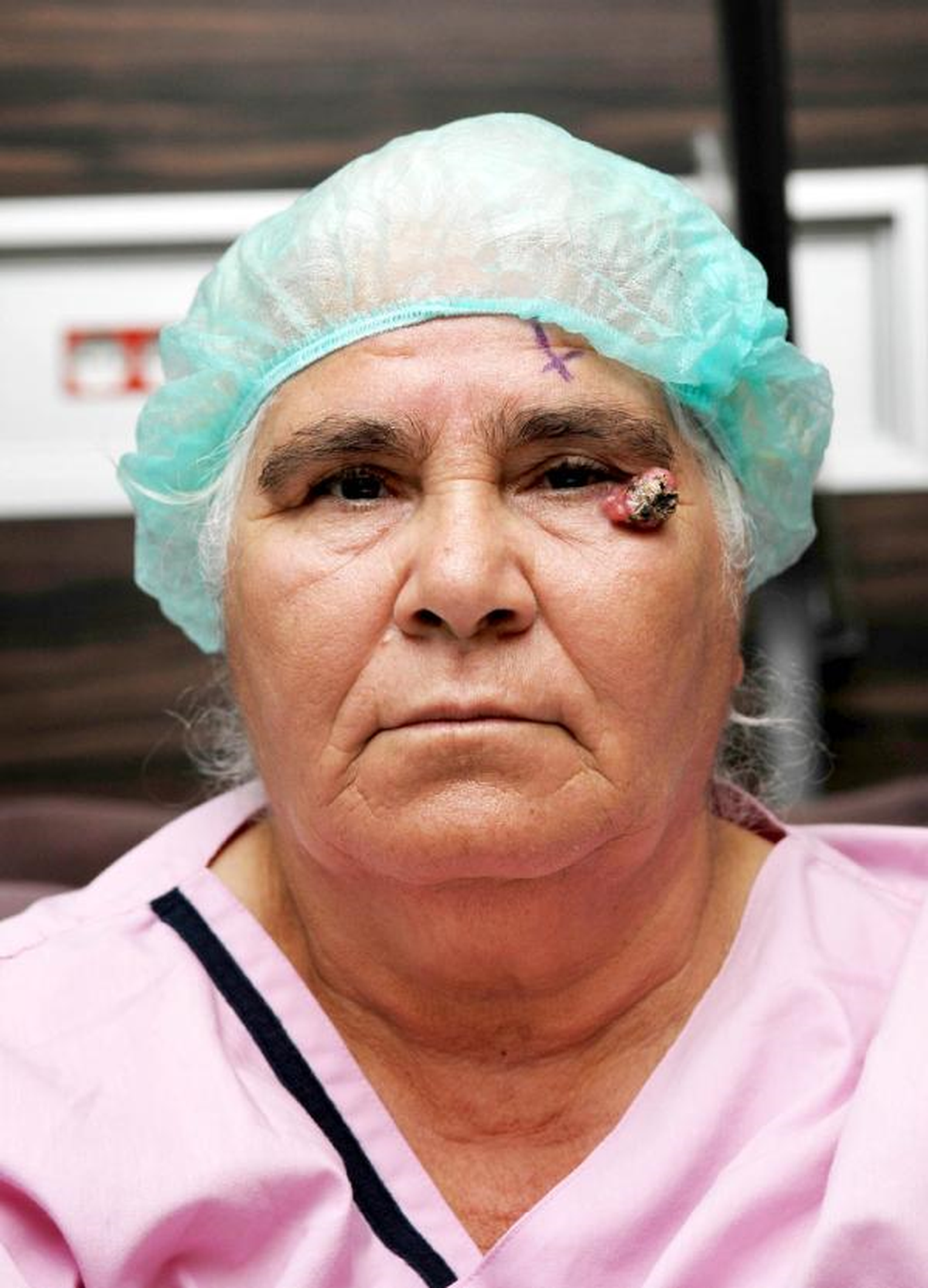 Göz Hastalıkları Uzmanı Ölmez: Güneş, Göz Tümörünü Tetikliyor