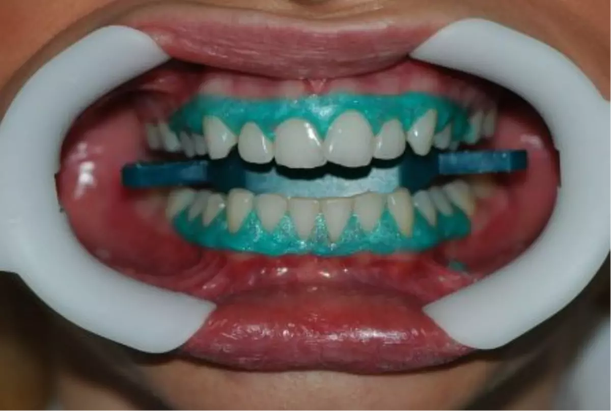 Dilediğiniz Gülümsemeye "Klinik 32" ile Kavuşun!