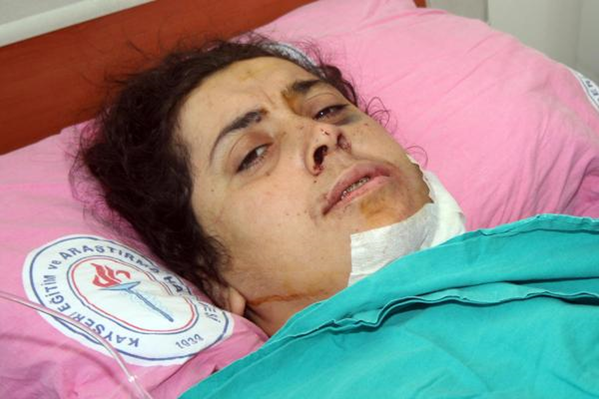 Koca Dayağı Çenesini Kırdı