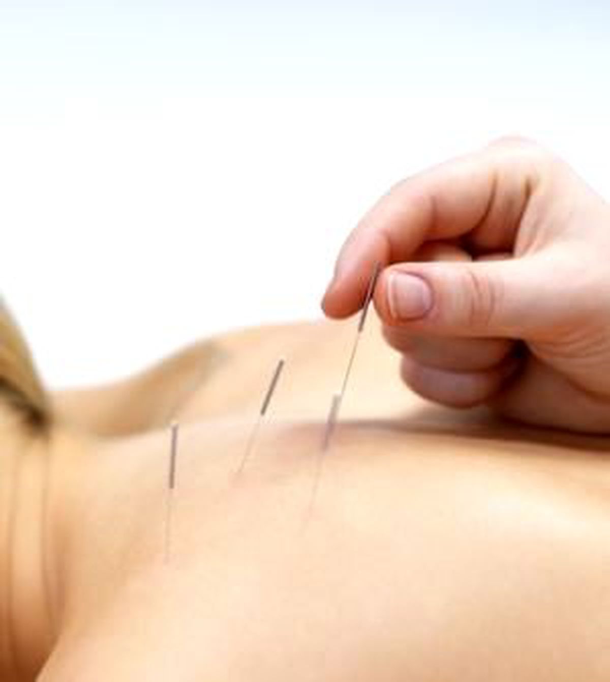 İnfertilite Tedavisinde Akupunktur Mucizesi