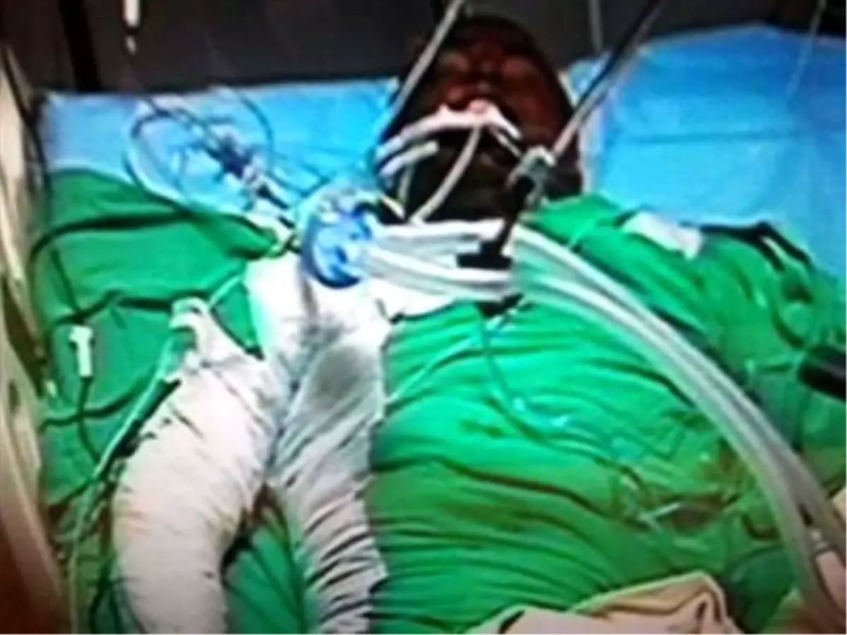 Cezaevinde Yanarak Yaralandı (2)