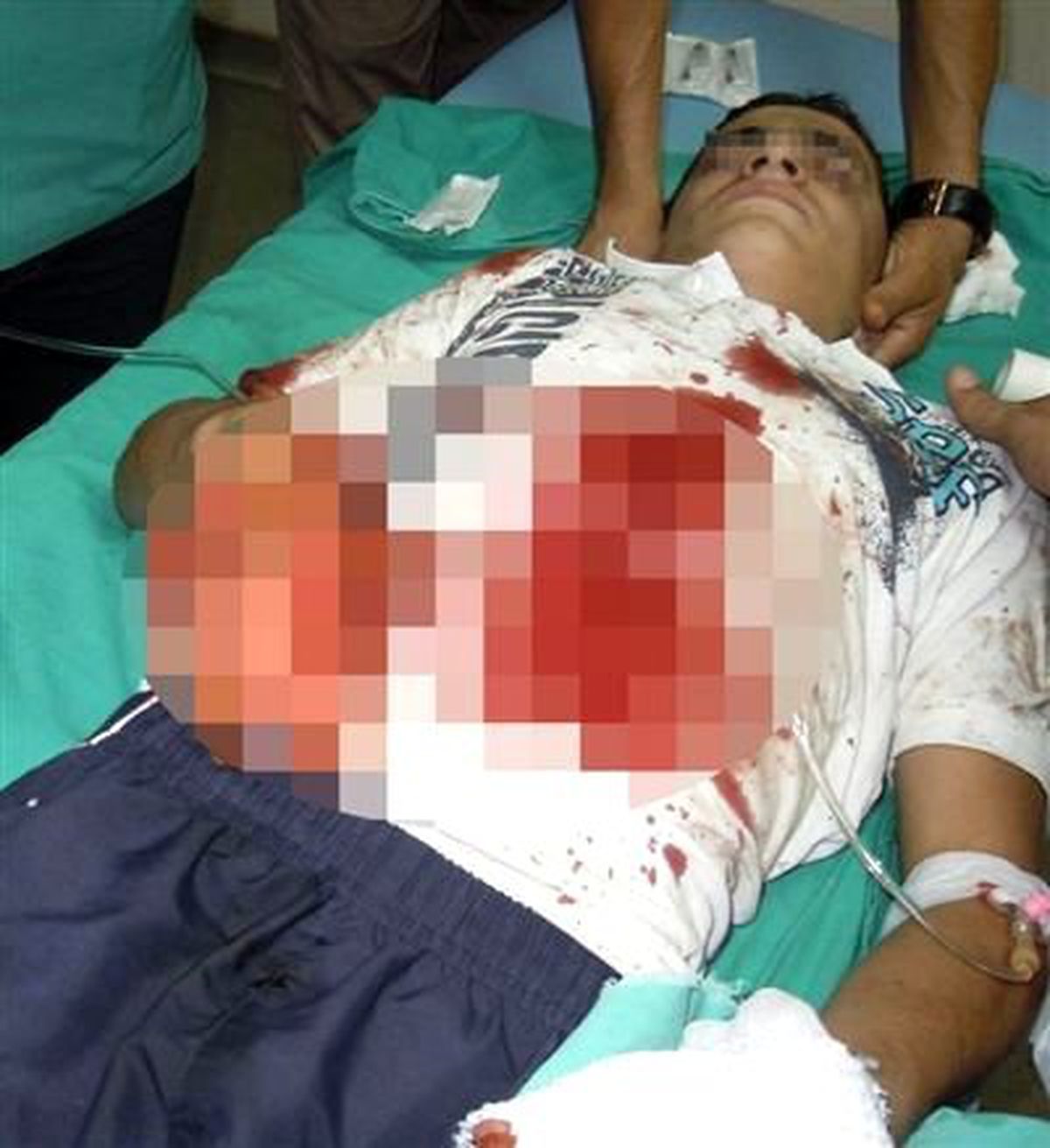 Polise Atmak İstediği Bomba Elinde Patladı, 2 Parmağı Kesildi