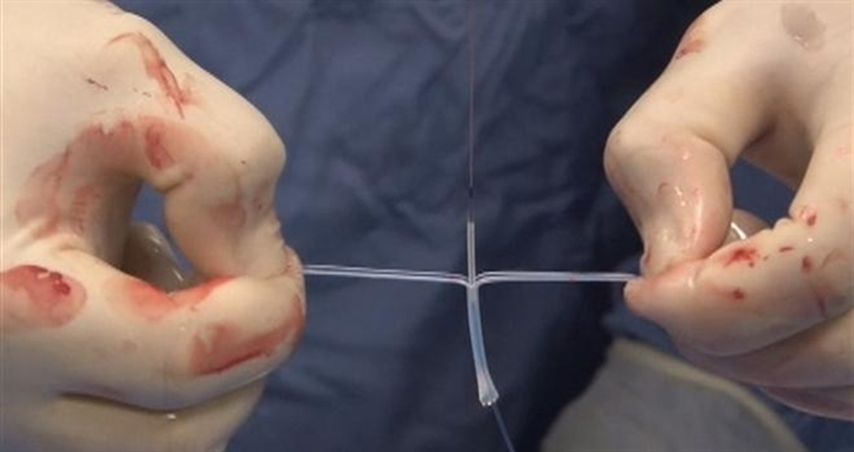 Damar İçine "Eriyebilen" Stent