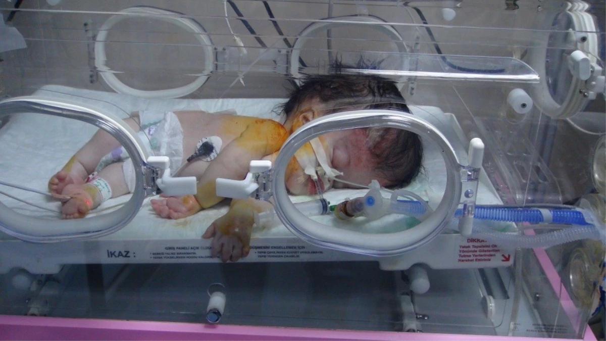 Kafası İki Katı Büyüklüğündeki Bebeğin Tedavisi Sürüyor