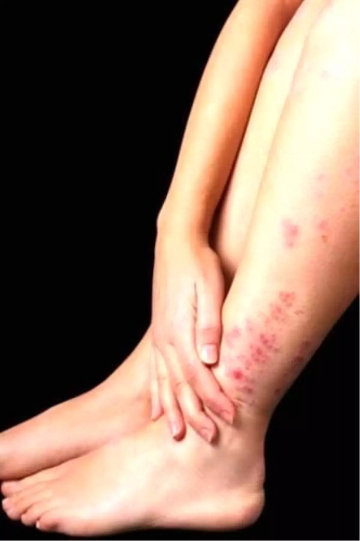 Sedef Başka Hastalıkların da Habercisi!