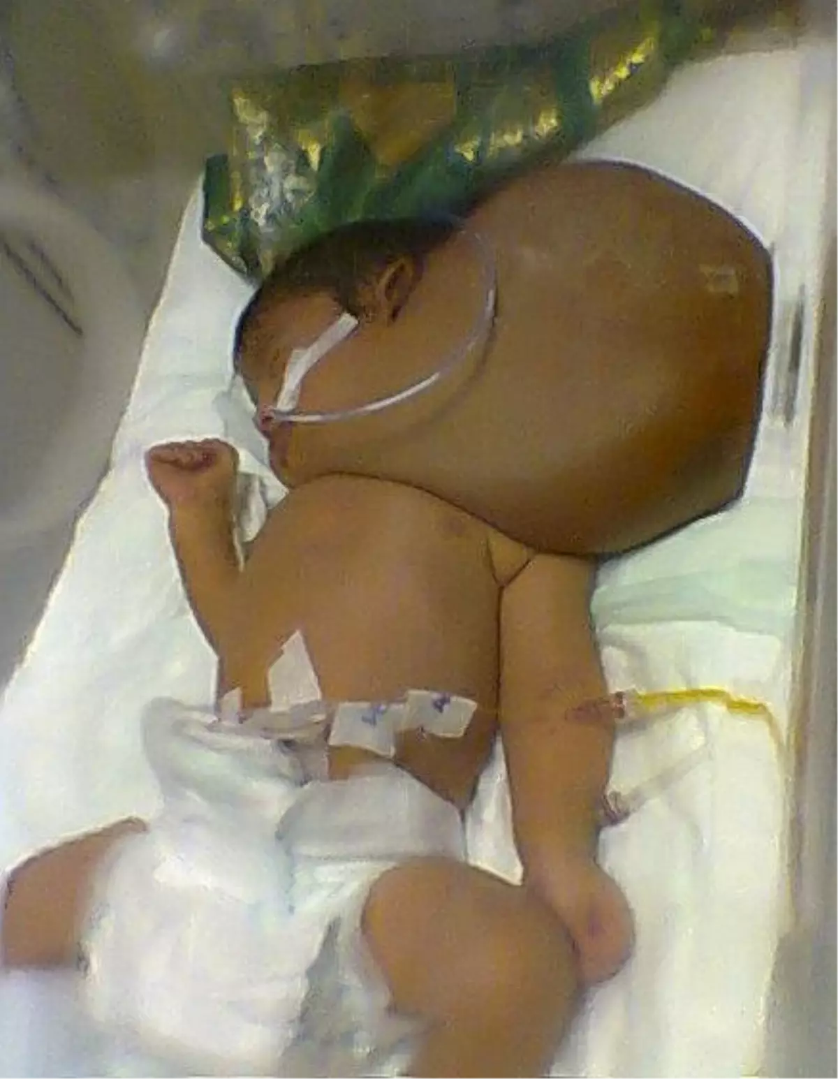 (Özel Haber) Kafasının 3 Katı Büyüklüğündeki Tümörden Kurtuldu