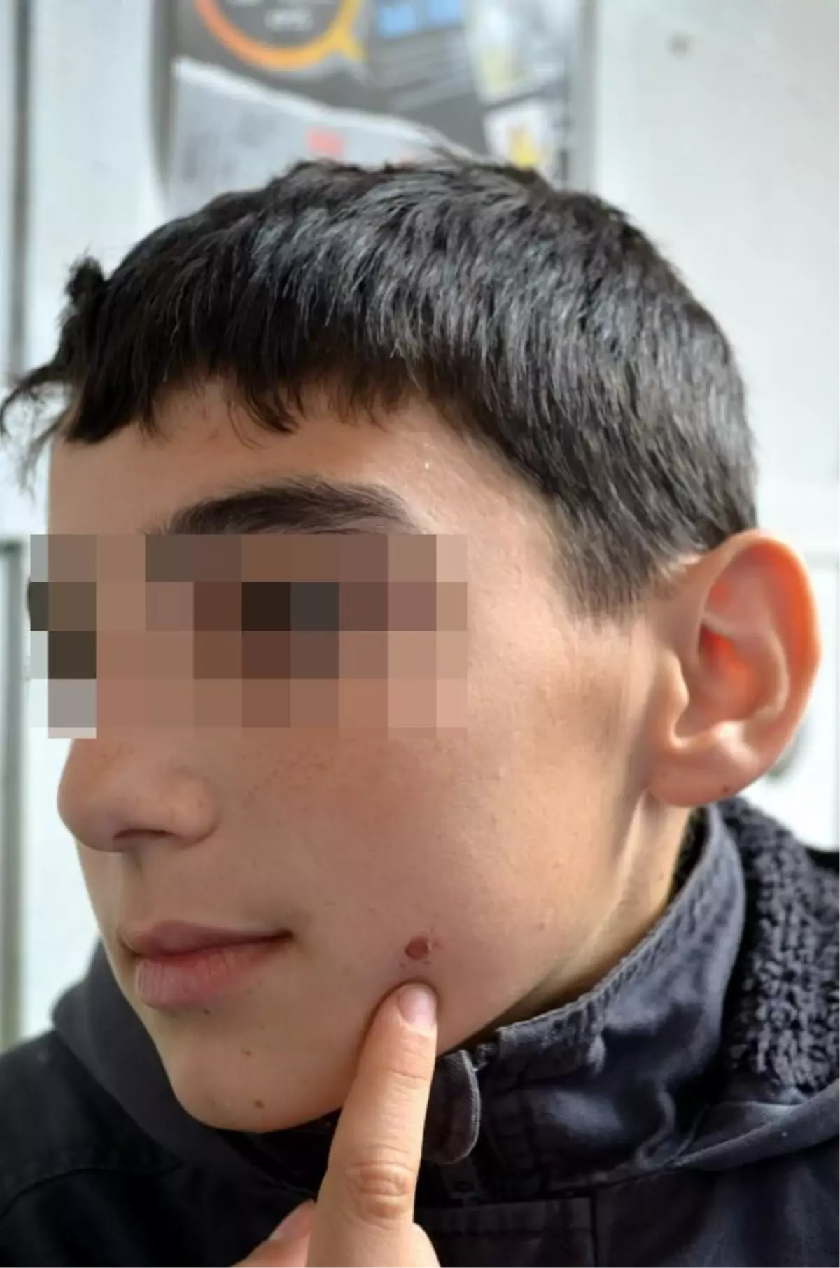 Harçlığını Alamaya Kalkıştığı Öğrencinin Yanağında Sigara Söndürdü