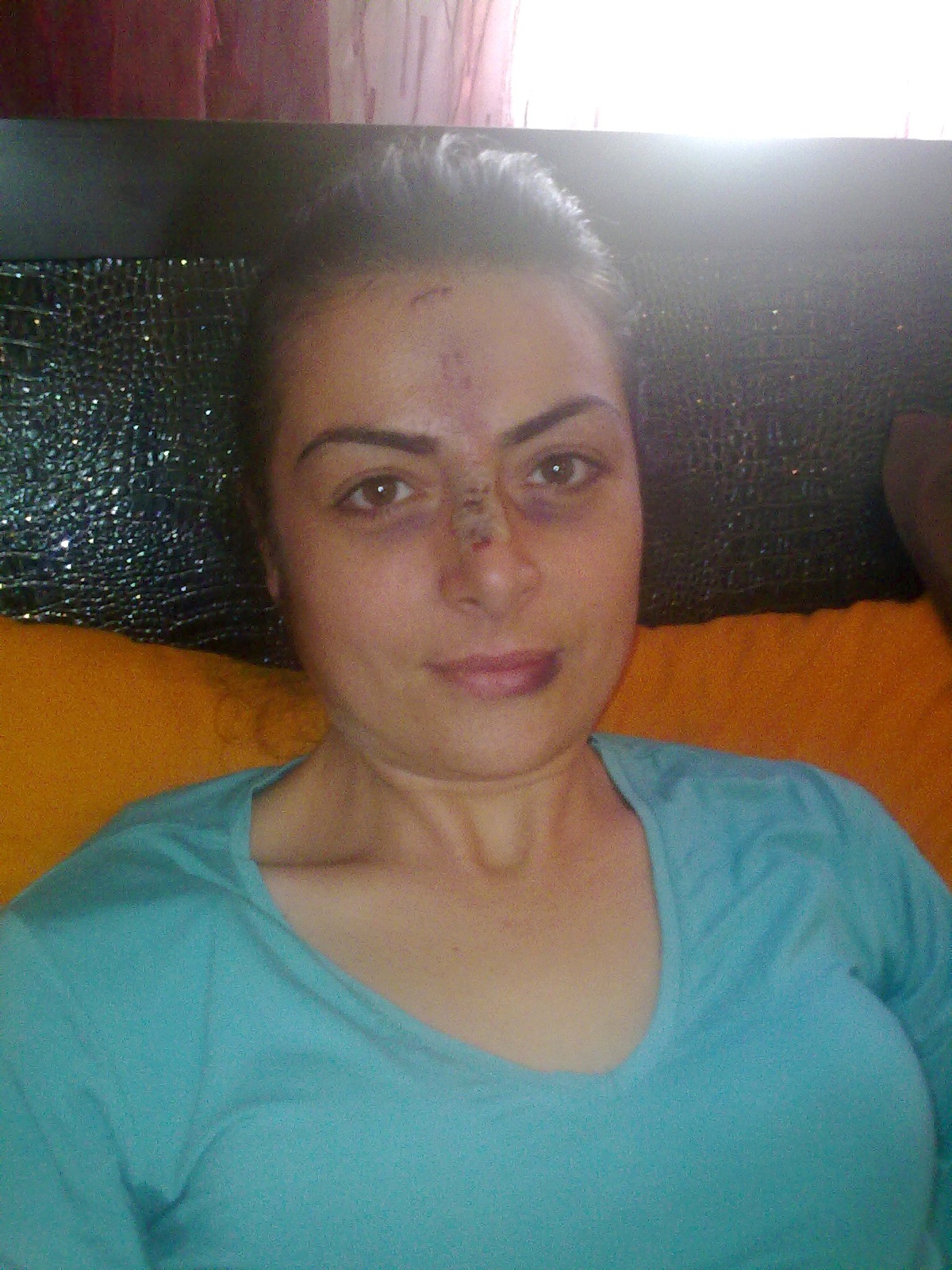 Köpeği Severken Yüzünden Yaralandı