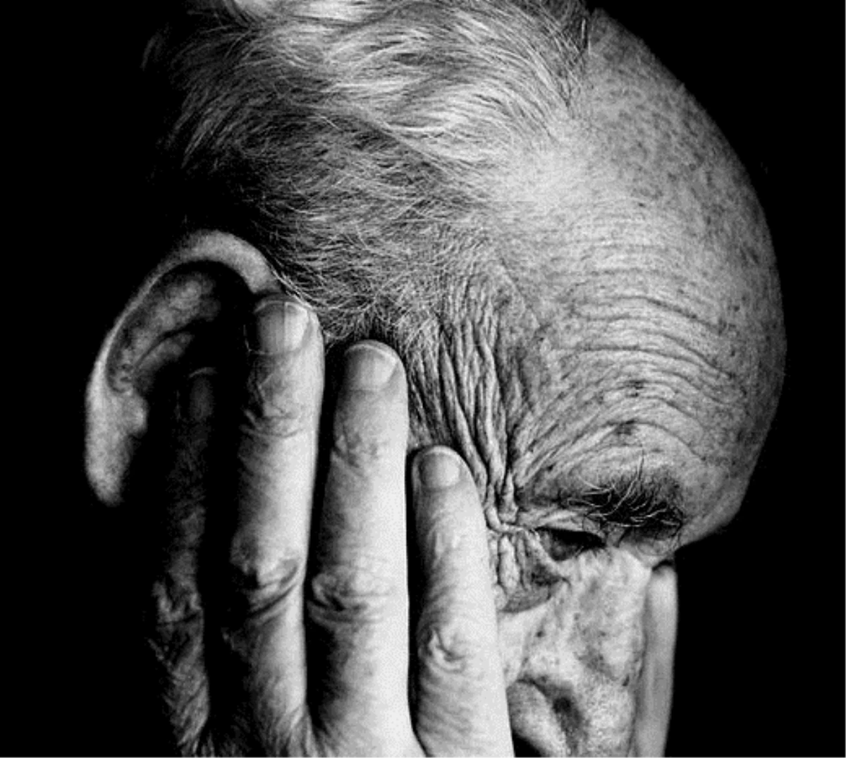 Sedef Hastalığı İlacı, Alzheimer\'a Umut Olabilir