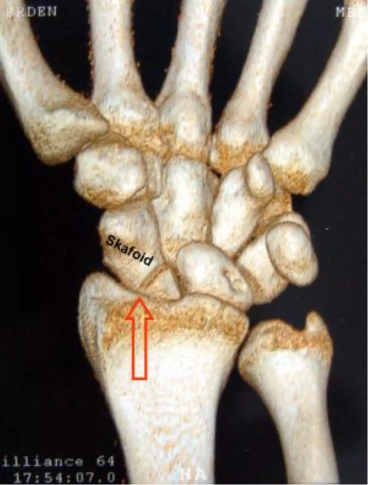 Skafoid Kemiği Nedir ve İşlevi Nedir?
