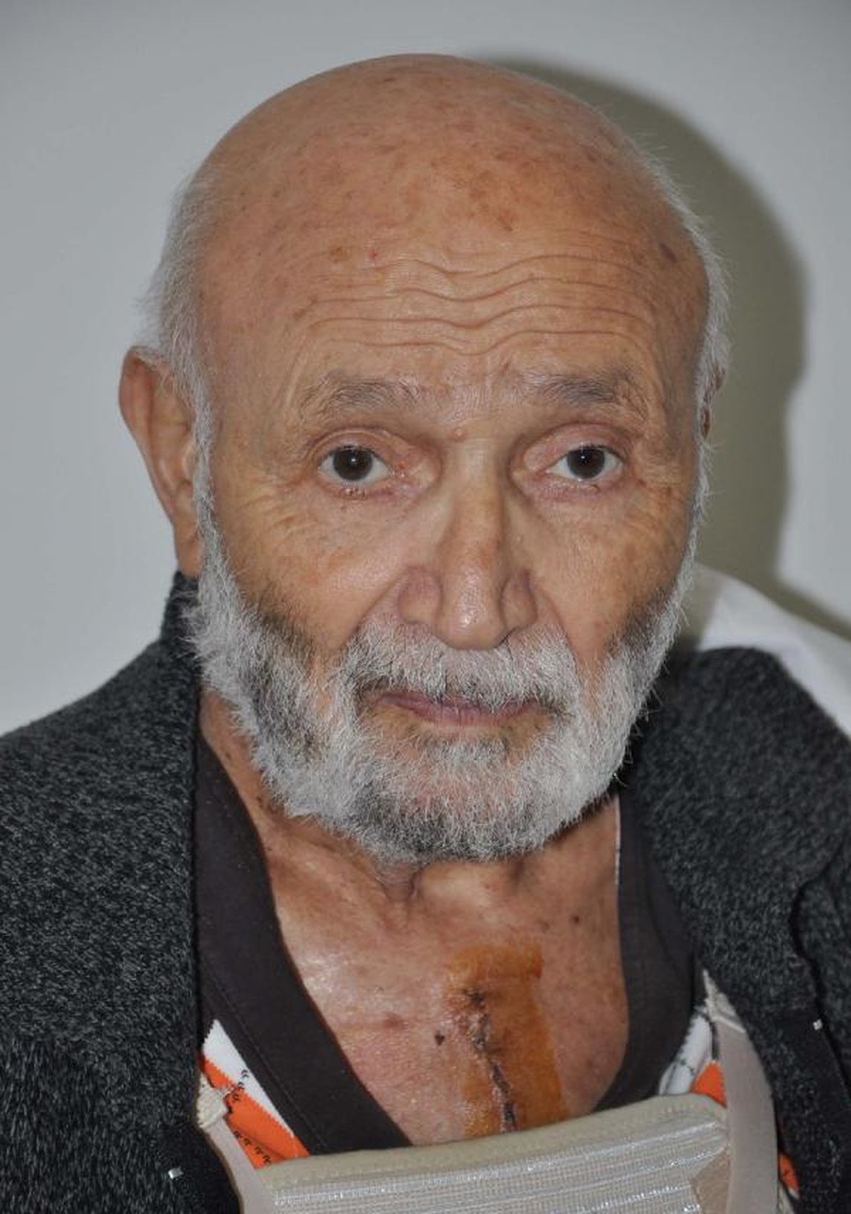 89 Yaşında By- Pass Oldu