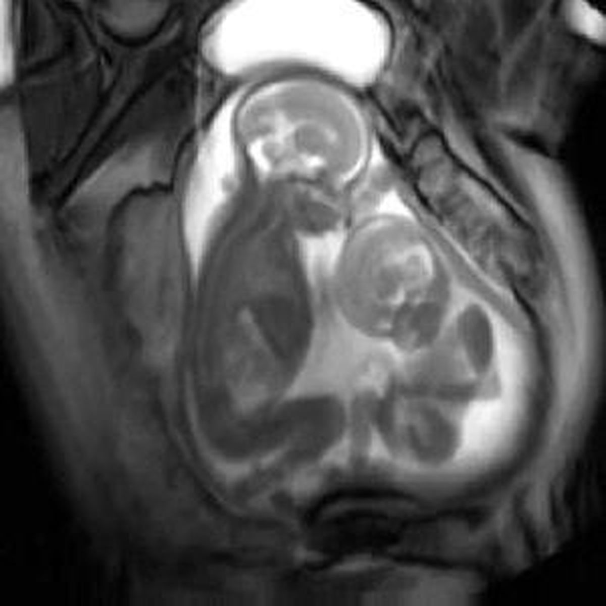 Anne Karnında Yer Kavgası