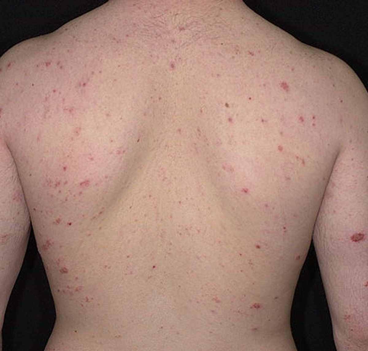 Egzama En Çok Görülen Meslek Hastalıklarından