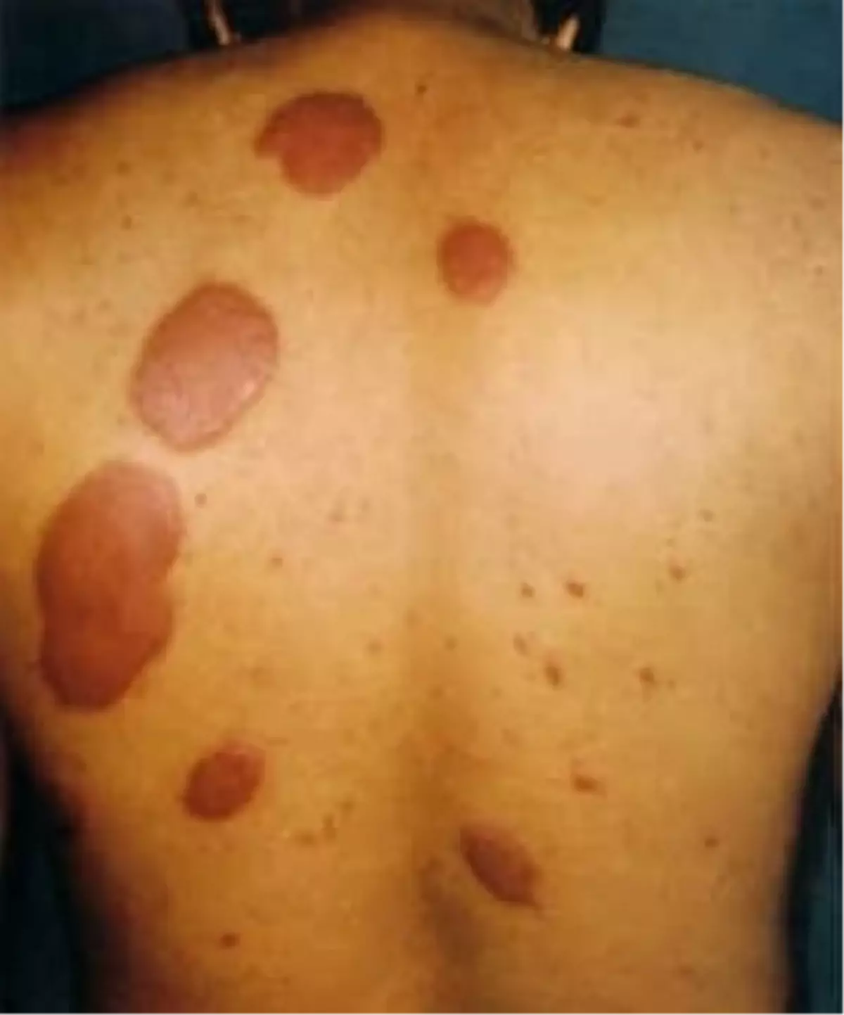 Didim Toplum Sağlığı Merkezi\'nden Cüzzam Bilgilendirmesi