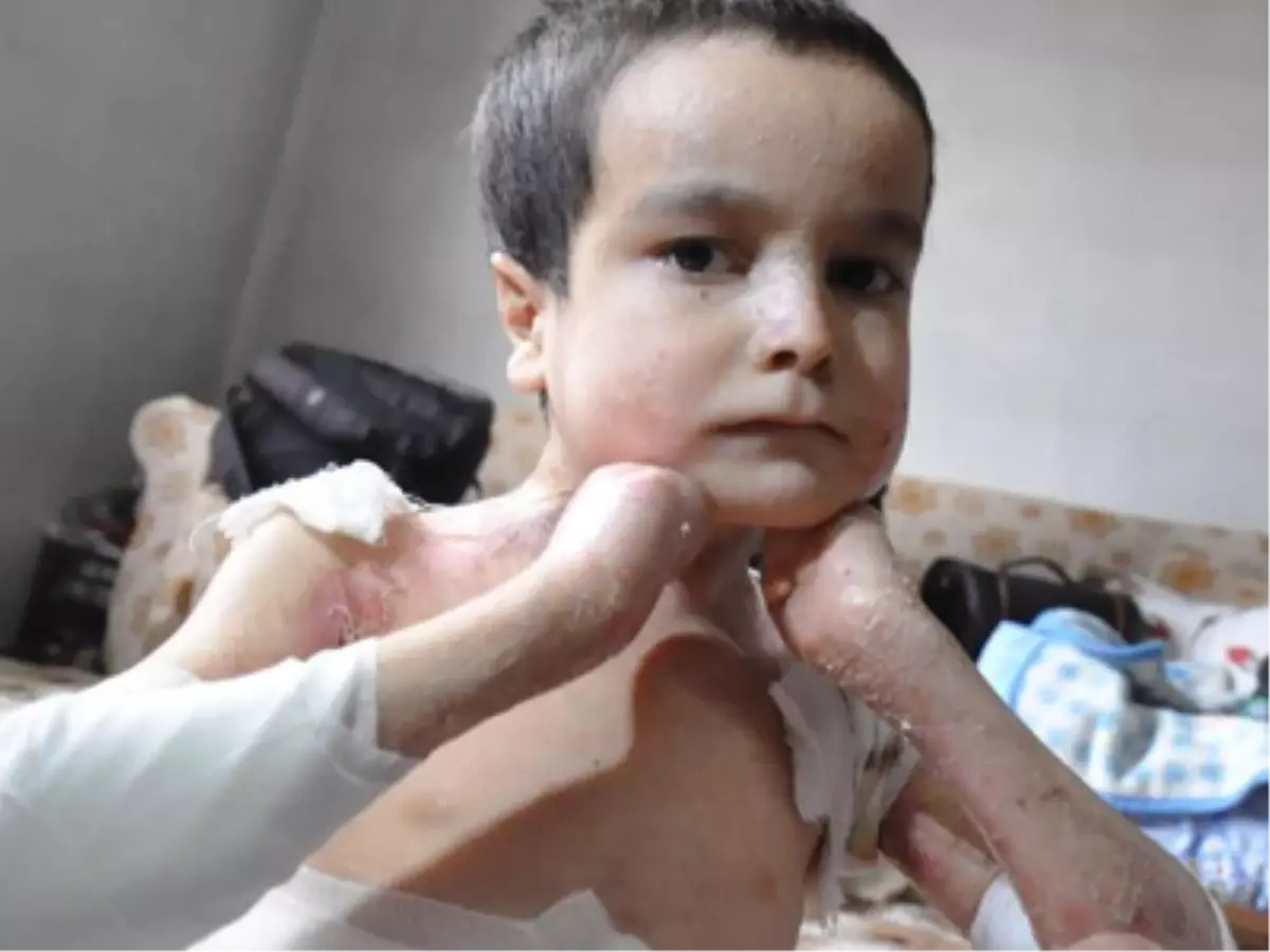 İki Kardeş Mum Gibi Eriyor