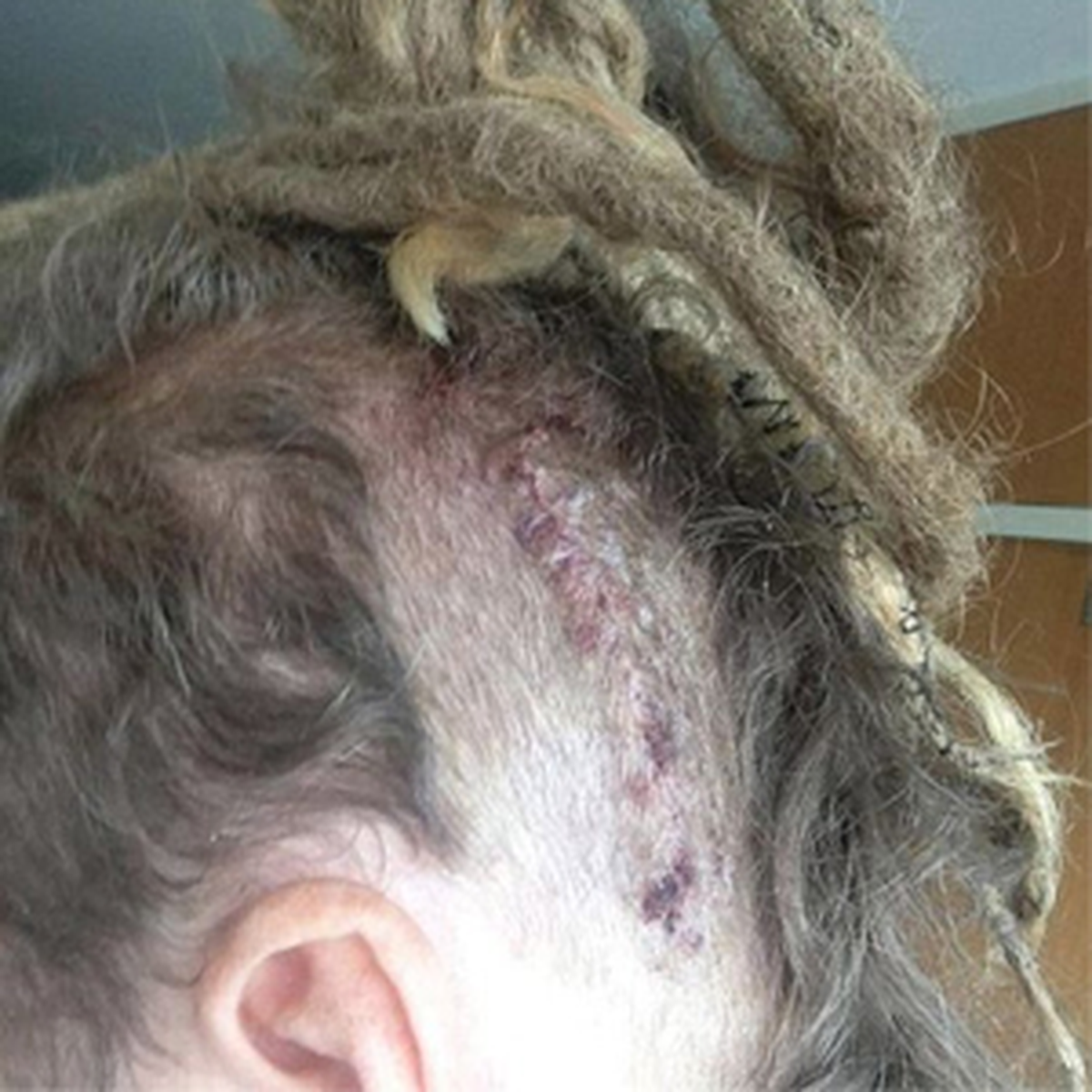 Tümör Sandı Beyninden Tenya Çıktı