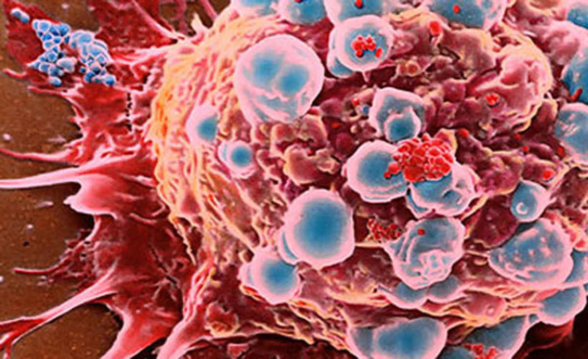 Obezite Geni, Cilt Kanseriyle Bağlantılı