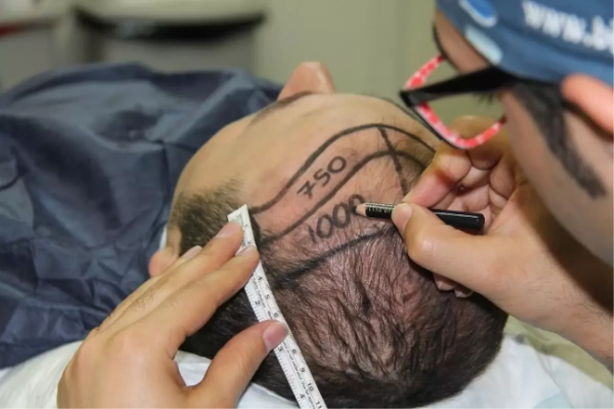 Saç Ekiminde Başarı Giderek Yükseliyor