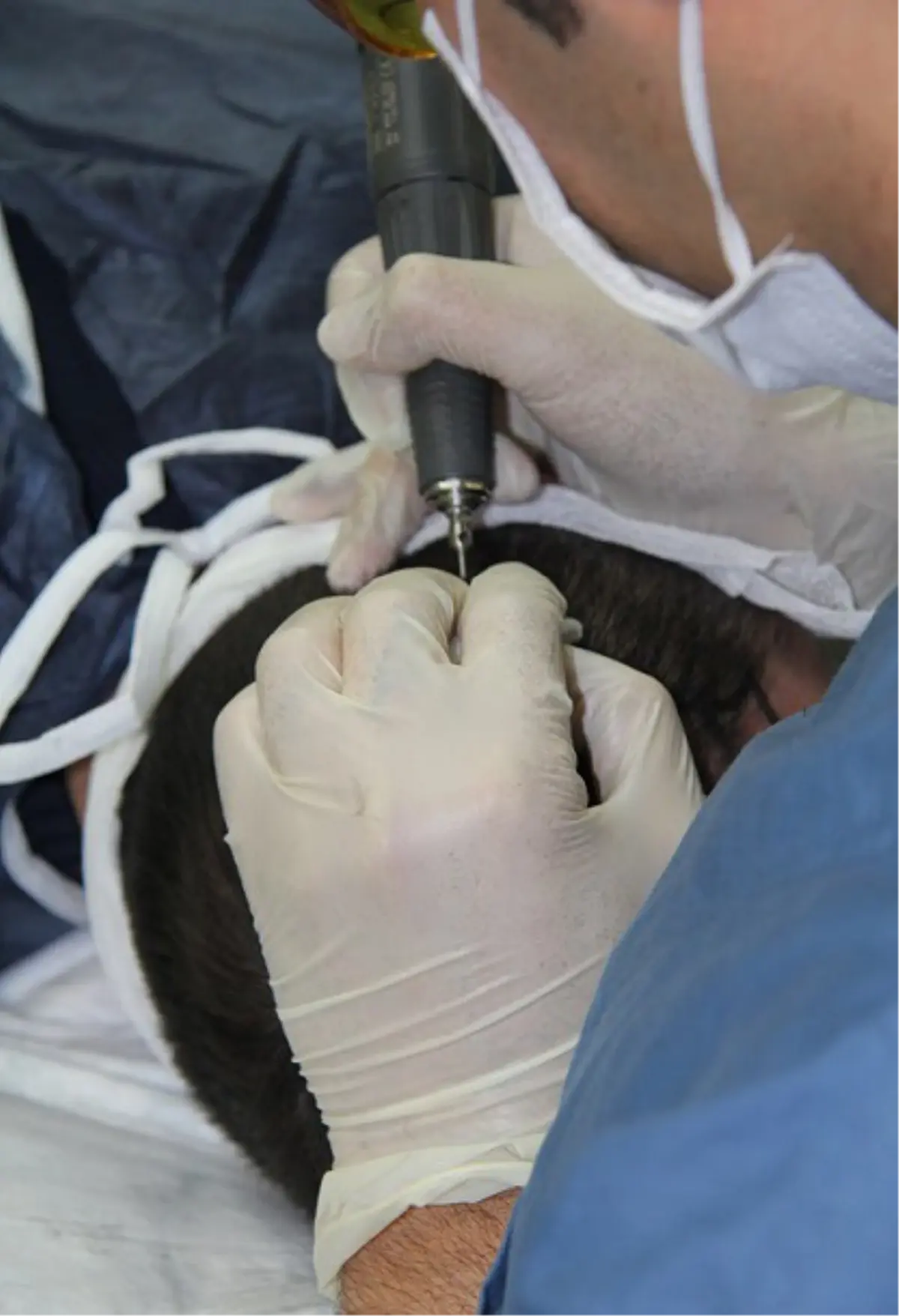 Saç Ekiminde Başarı Yükseliyor