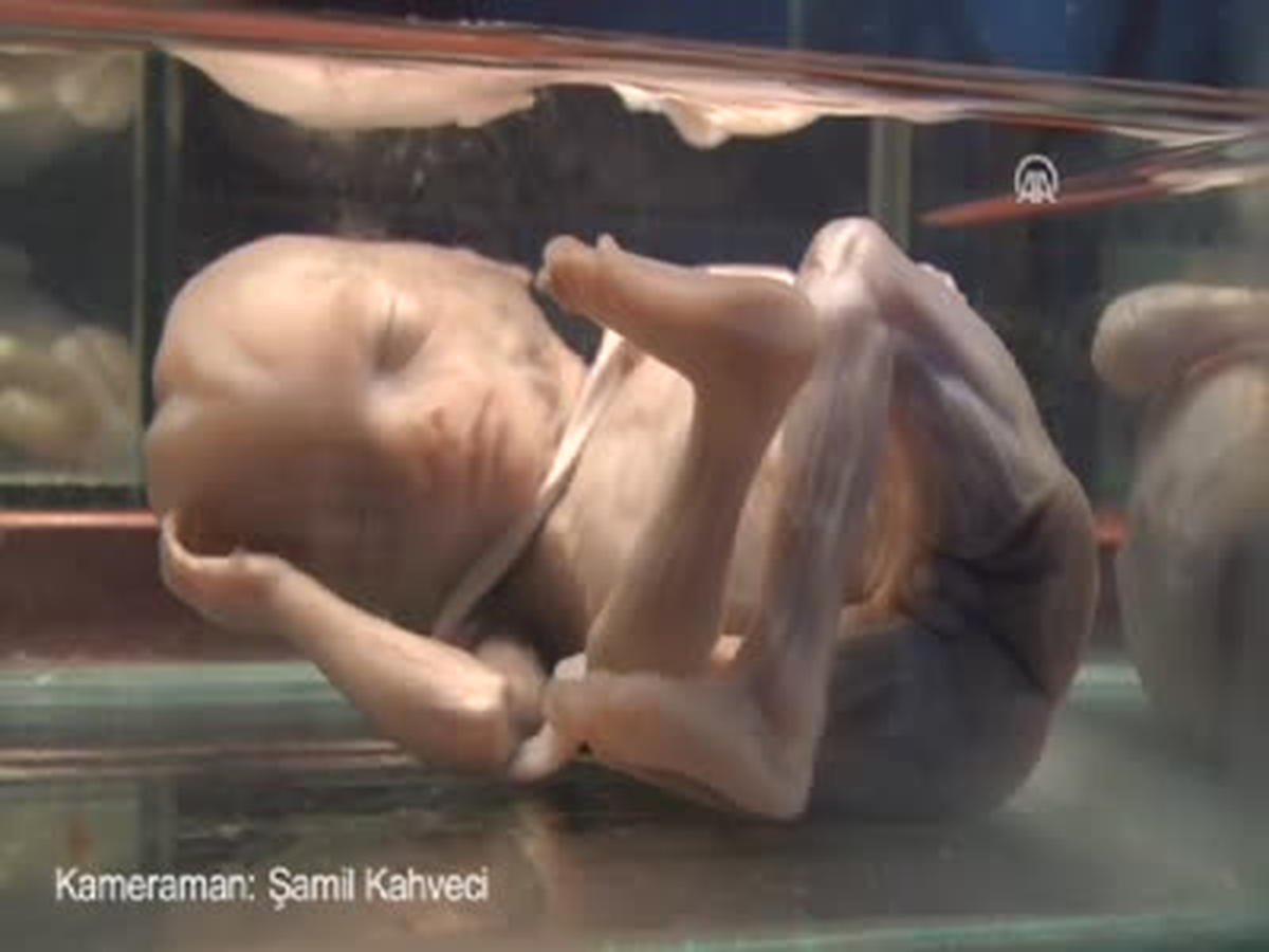 Fetuslardan Koleksiyon Yaptı