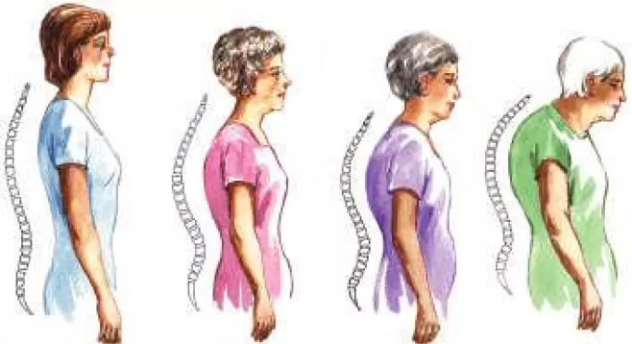 Hareketsiz Yaşam Kemik Erimesine Yol Açıyor