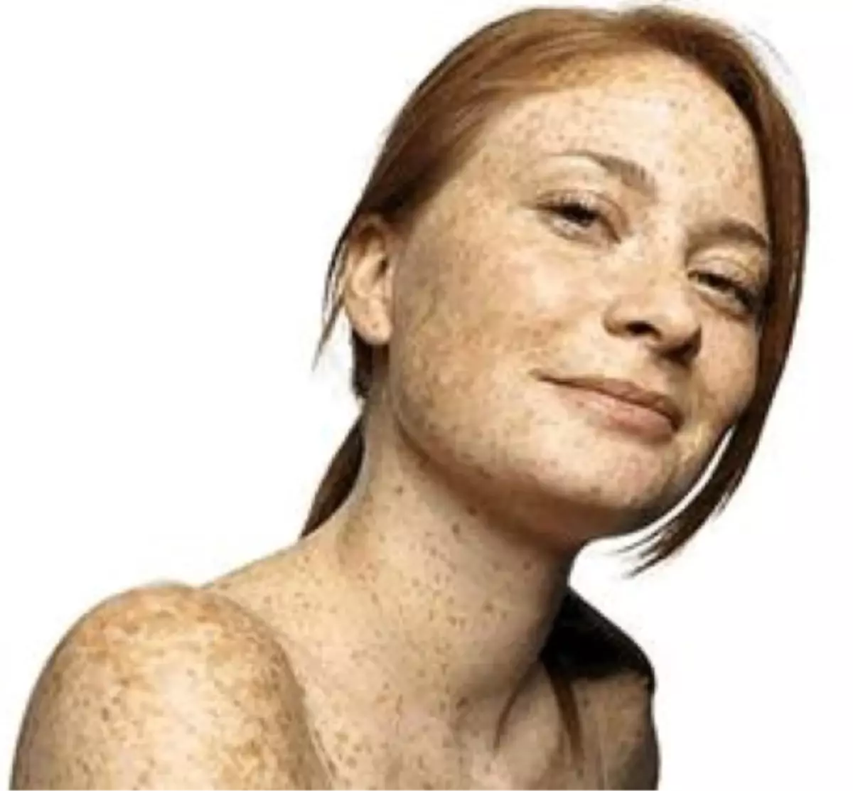 Cilt Lekeleri Nasıl Geçer?