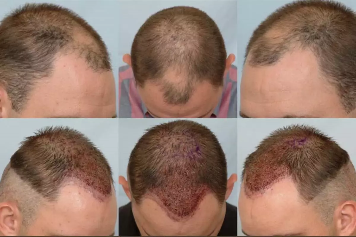 Saç Ekimi'nde İkinci Seans Önemli