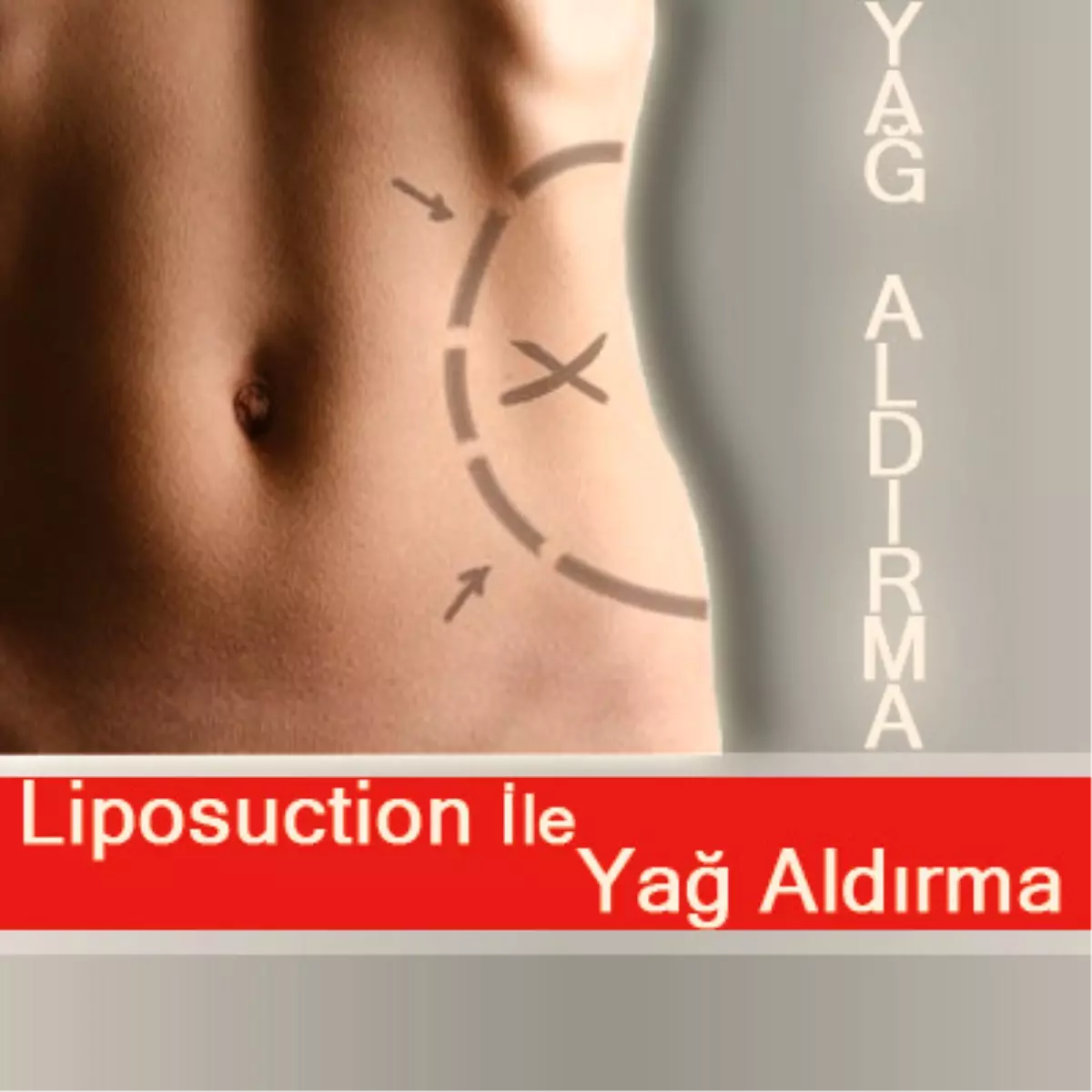 Liposuction Nedir?
