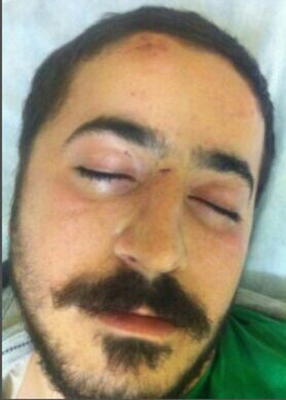 Gezi Parkı Eylemlerinde Yaralanan Üniversiteli Yaşam Mücadelesi Veriyor