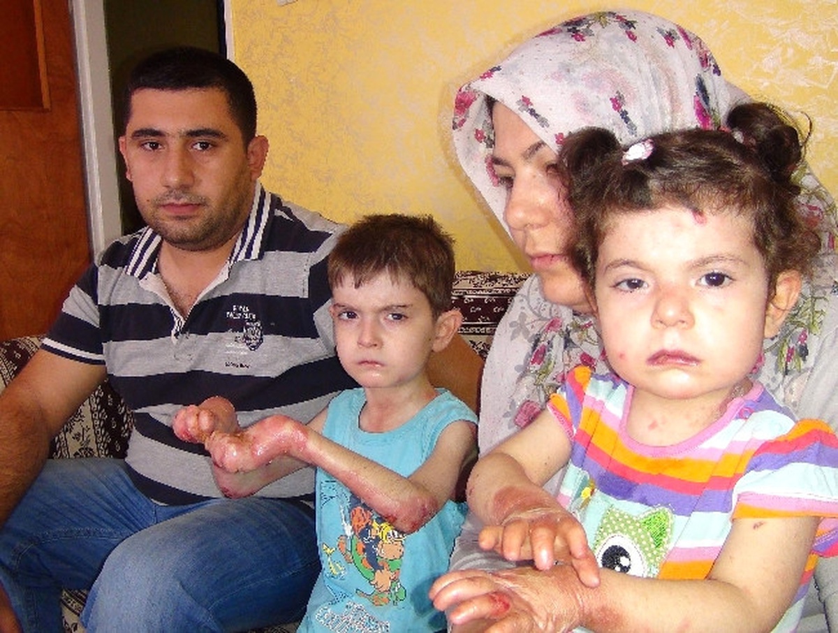 (Özel Haber) Deri Dökülmesi Hastalığına Yakalanan Kardeşlerin Ölüm Kalım Savaşı