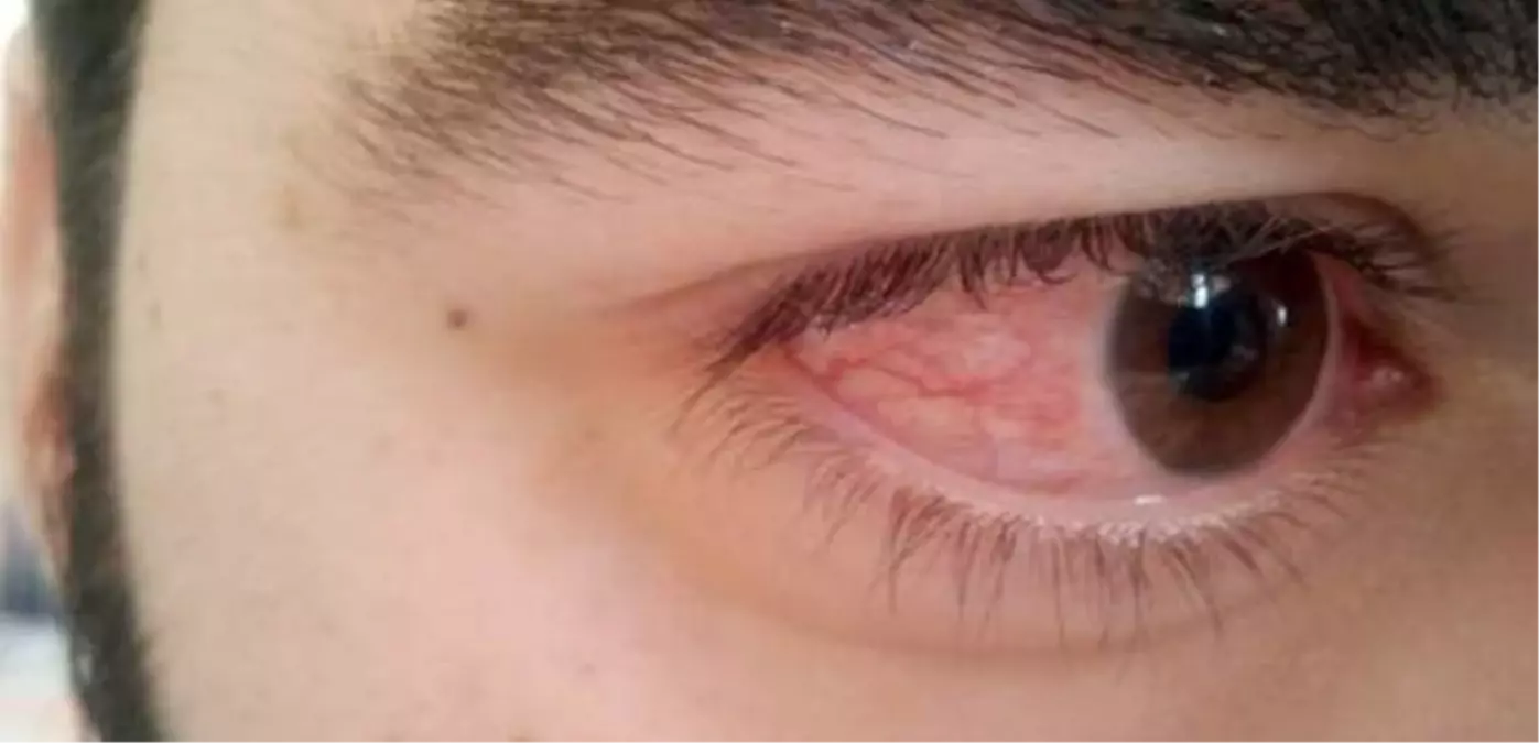 Göz Kanlanmasına Dikkat Edin