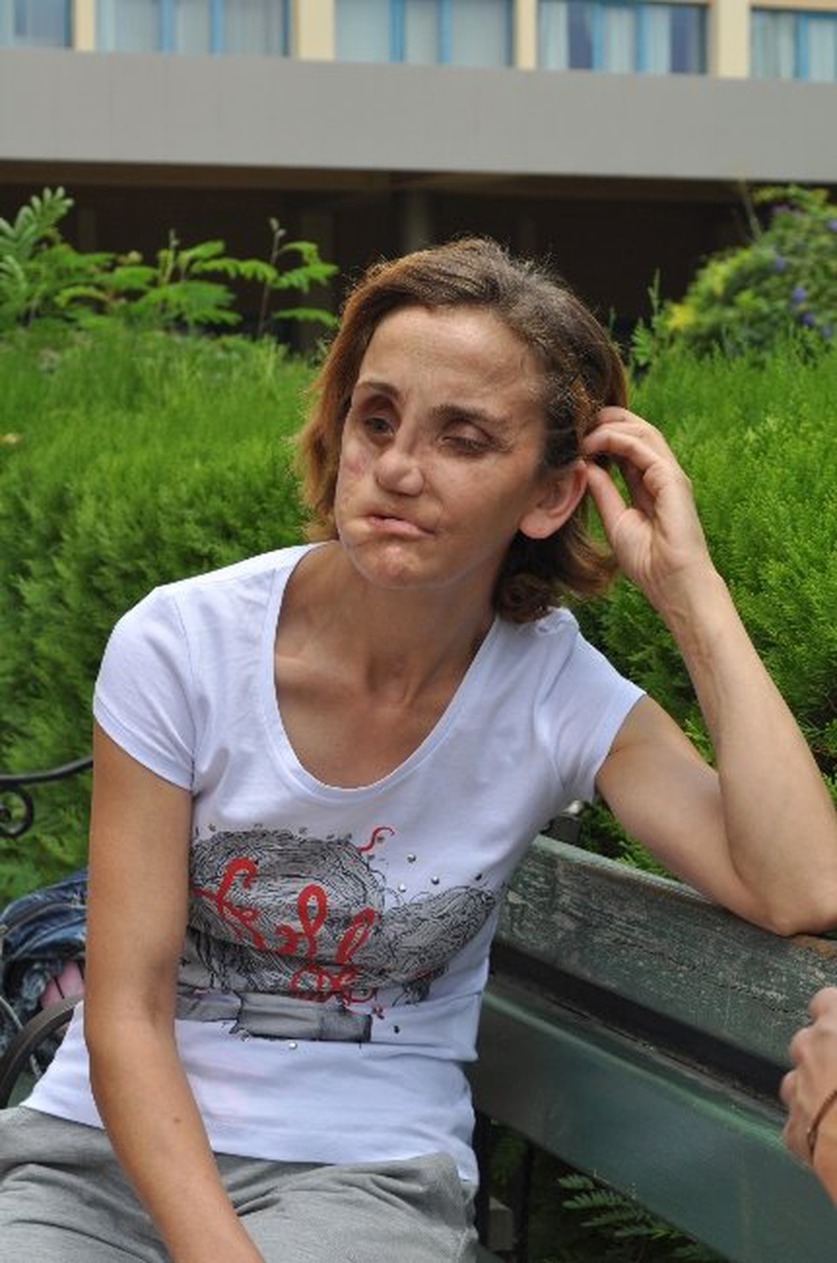 Beşinci Yüz Nakli, Selvinaz\'a Umut Oldu