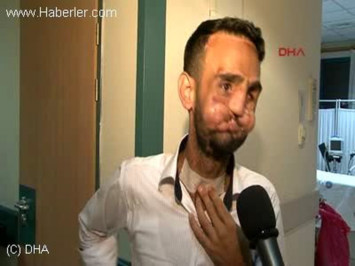 5. Yüz Nakli Yapılan Operasyonun Görüntüleri