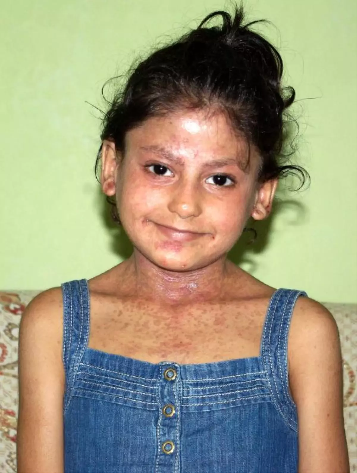 Minik Büşra\'ya Hayat Işığı Göründü