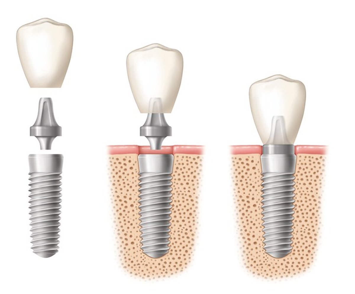 Türk "Dental İmplant" Sektörü Dünyaya Açılıyor