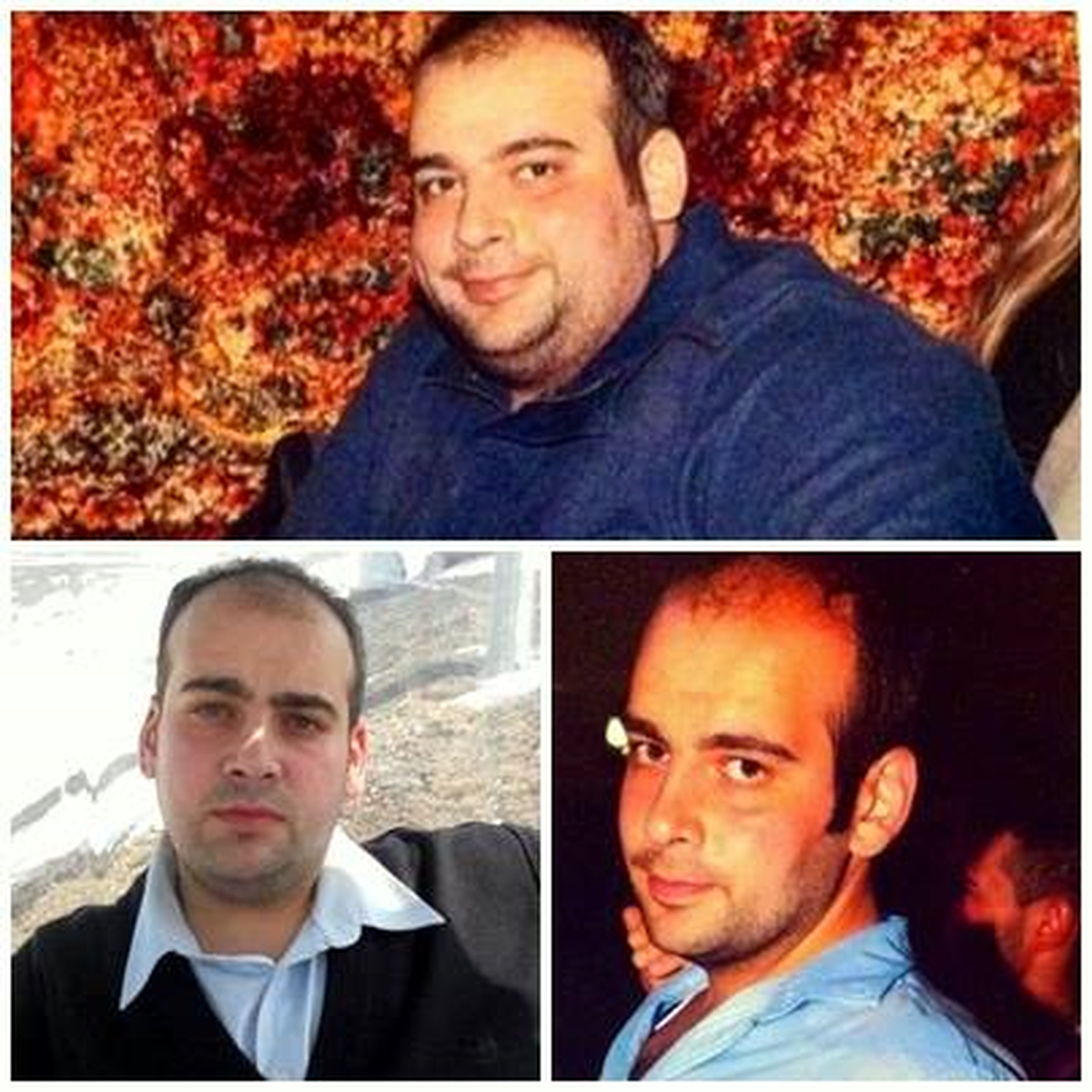 Midesini Küçülttü 75 Kilo Verdi
