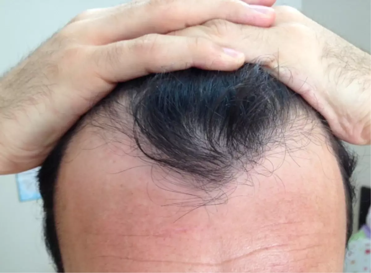 Saç Dökülmesinin Psikolojik Sonuçları