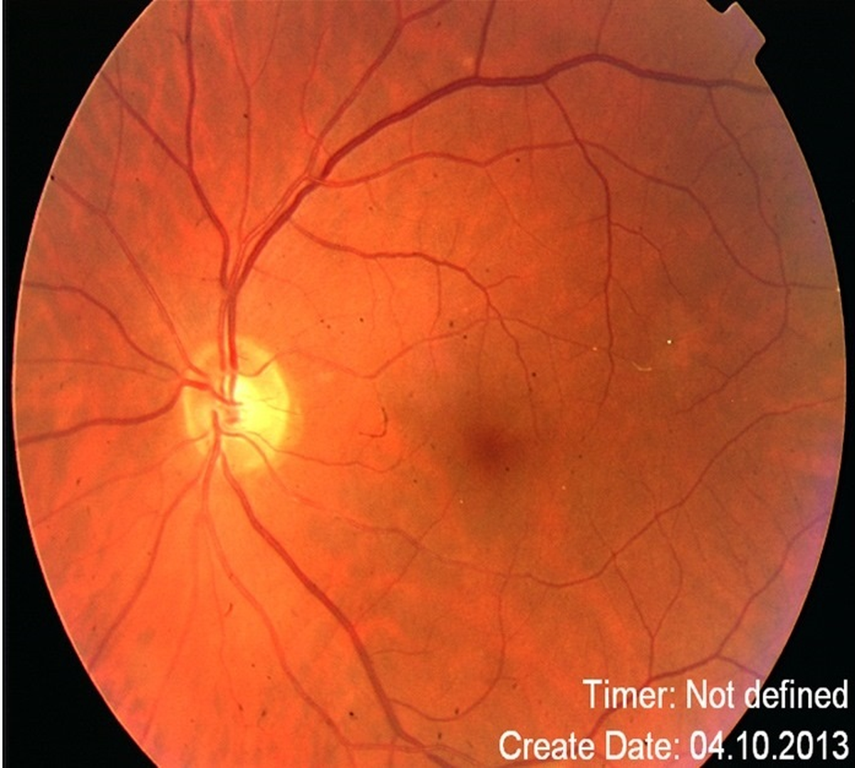 Retina Damarlarındaki Tıkanıklık, Kalp Hastalıklarının Habercisi