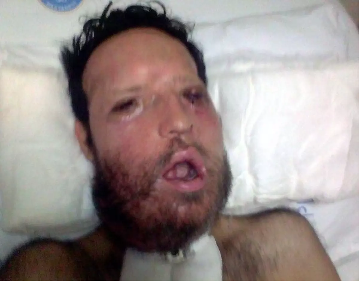 Yüz Nakli Yapılan Recep Sert\'e Fotoraf ve Röportaj Yasağı