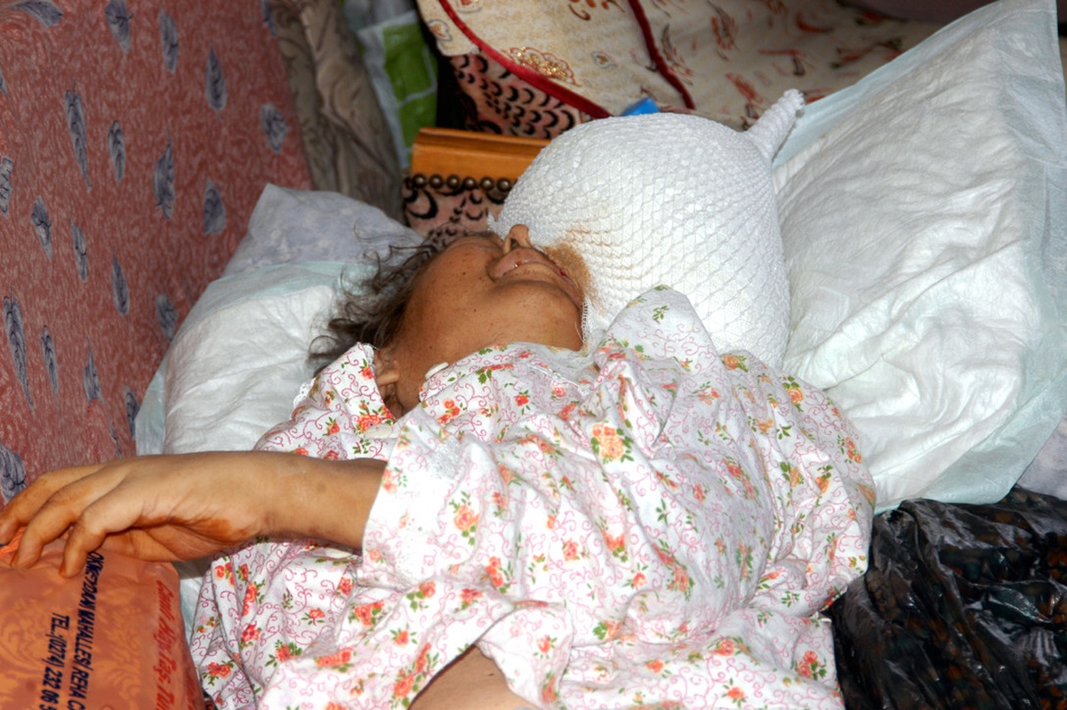 Kafasındaki 7 Kilogramlık Tümörle Yaşıyor