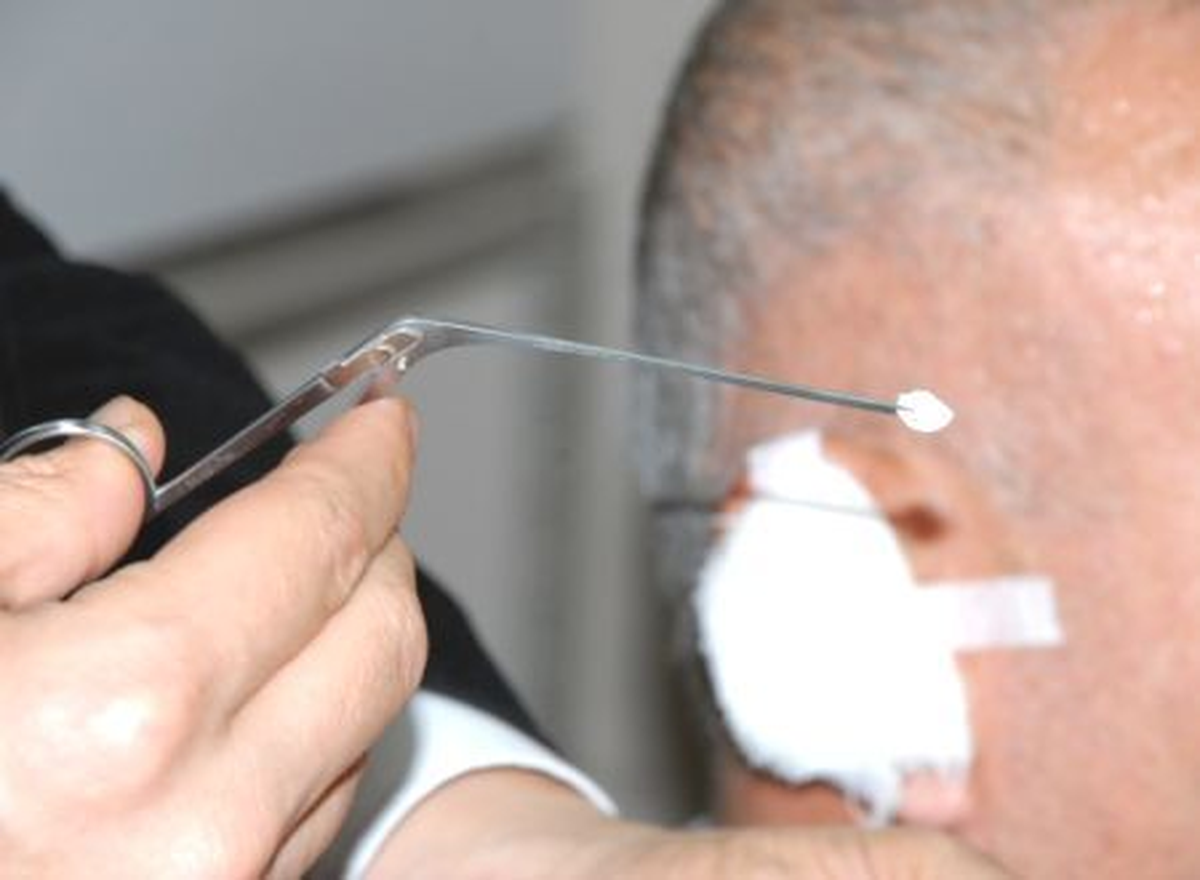 Sigara Kağıdıyla Kulak Zarı Tedavisi