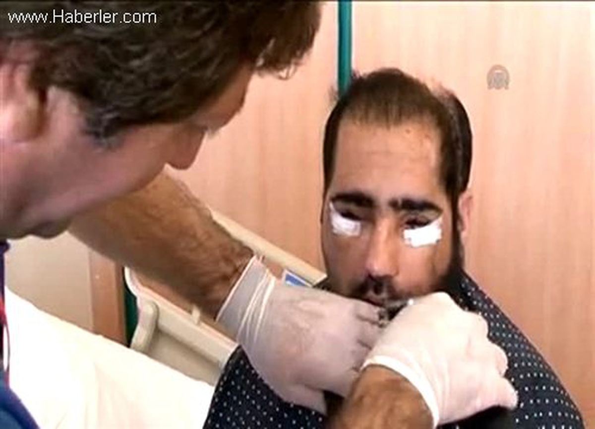 6\'ncı yüz nakli yapılan Salih Üslün\'ün son hali