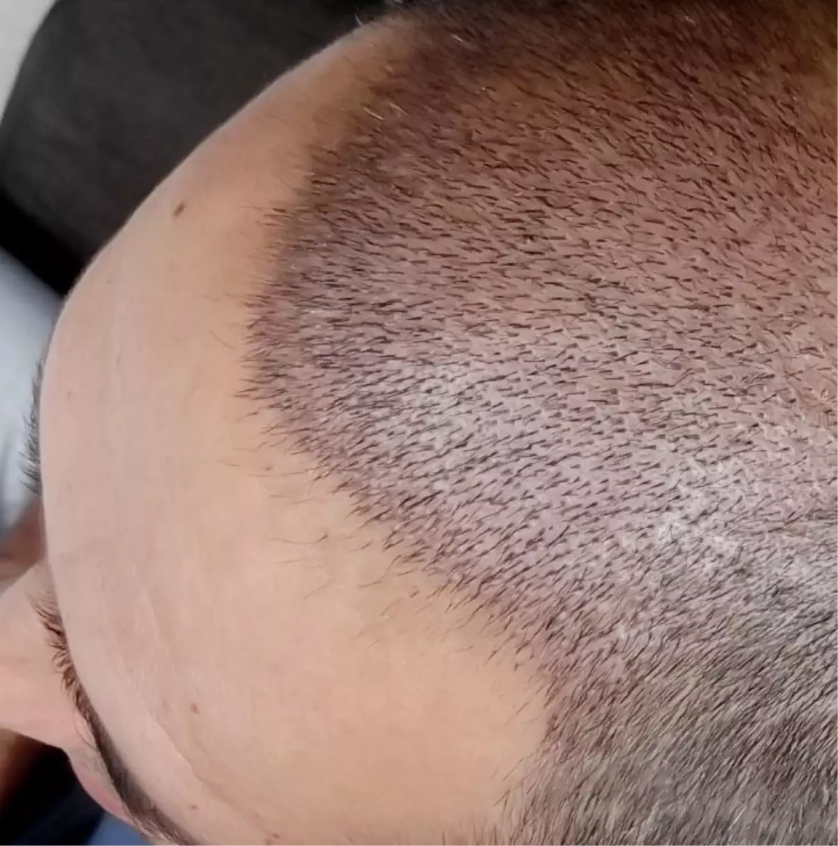 En Doğal Saç Ekim Tekniği: Fue Perkutan