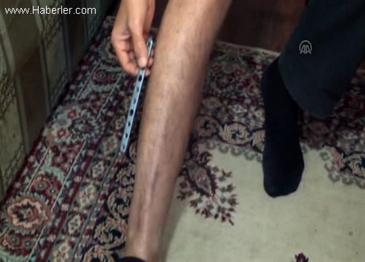 Ameliyatla ayağına takılan platin kırılınca