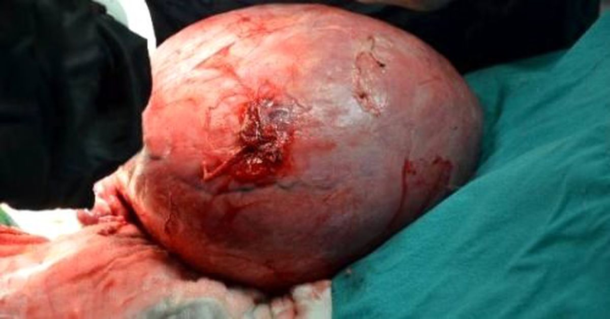 Hastanın Rahminden 7 Kilo Kitle Çıkartıldı