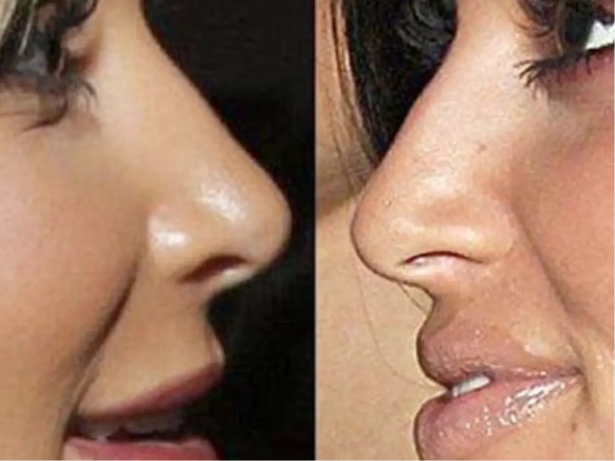 Kim Kardashian Yıllar Önce Burun Estetiği Yaptırmış