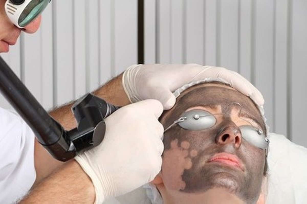 Peeling ve Q Switch Lazer ile Yılbaşına Yenilerek Girin
