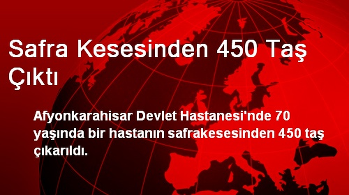 Safra Kesesinden 450 Taş Çıktı